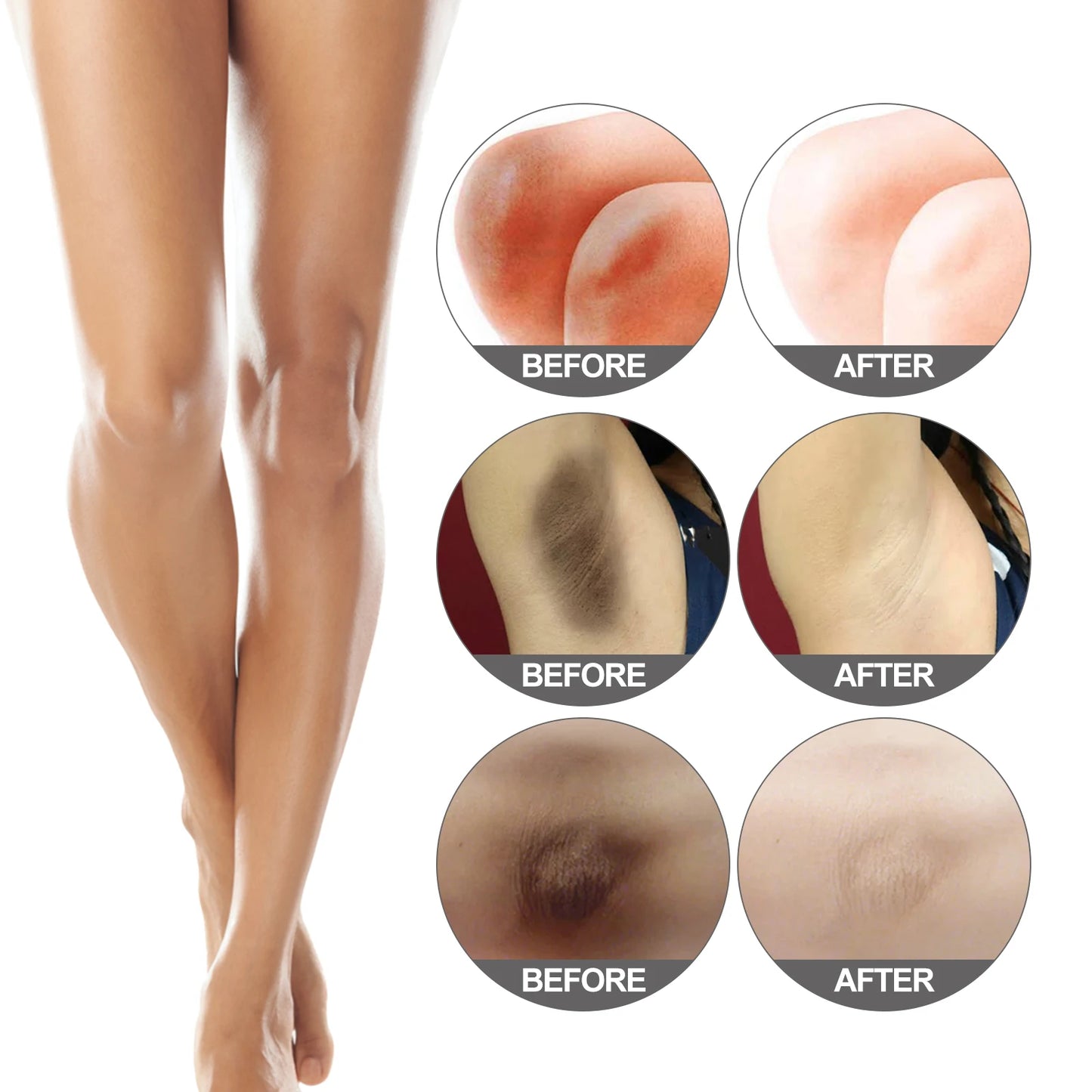 Body Whitening Bleach Cream Brighten Underarm Elbow Knees Joint Removal Intimate Parts Dark Spots Melanin Snow Bleach Cream 30ml