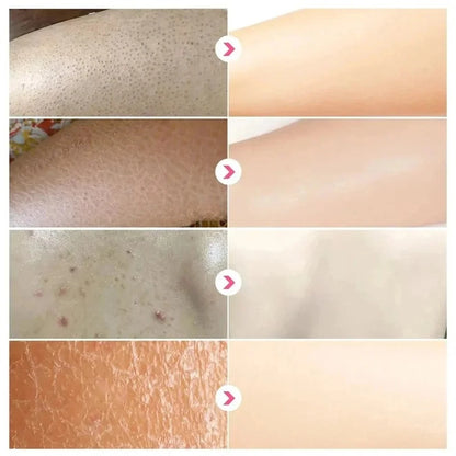 Curing Keratosis Pilaris Chicken Follicle Skin Repair Cream Body Dark Spot Remove Whitening Smooth Moisturize Skincare Body loti