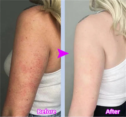 Curing Keratosis Pilaris Chicken Follicle Skin Repair Cream Body Dark Spot Remove Whitening Smooth Moisturize Skincare Body loti