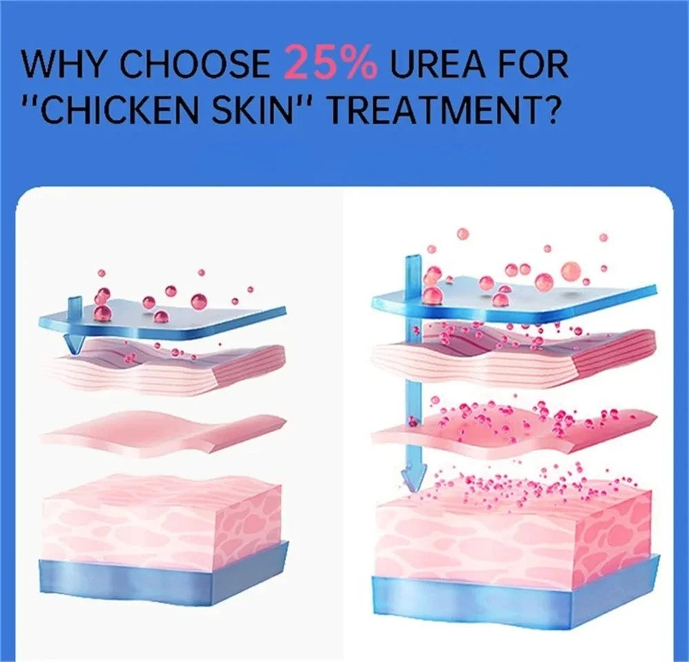 Curing Keratosis Pilaris Chicken Follicle Skin Repair Cream Body Dark Spot Remove Whitening Smooth Moisturize Skincare Body loti