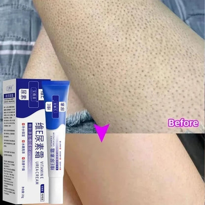 Curing Keratosis Pilaris Chicken Follicle Skin Repair Cream Body Dark Spot Remove Whitening Smooth Moisturize Skincare Body loti