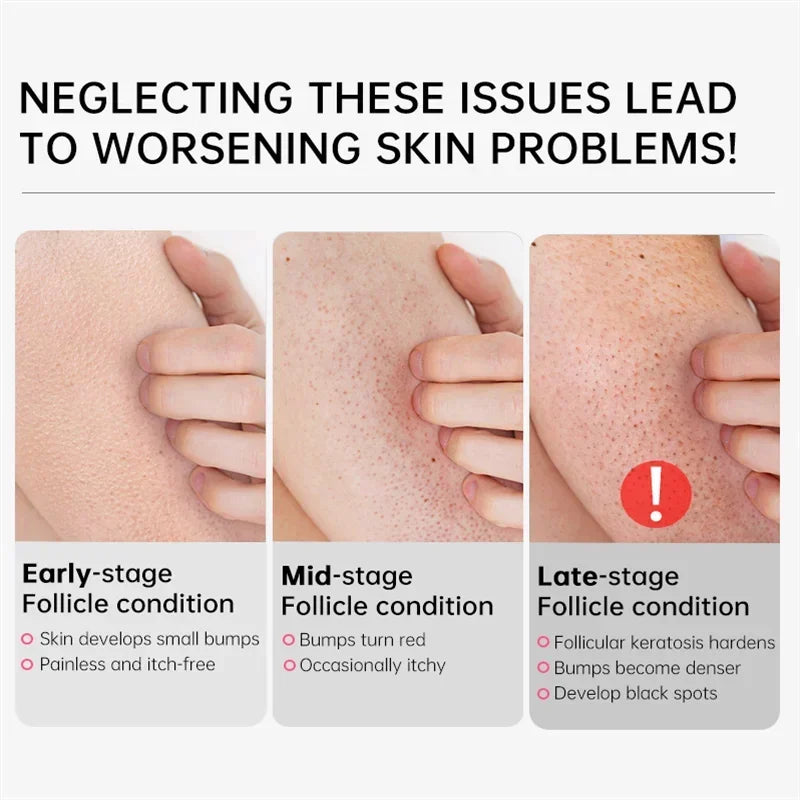Curing Keratosis Pilaris Chicken Follicle Skin Repair Cream Body Dark Spot Remove Whitening Smooth Moisturize Skincare Body loti