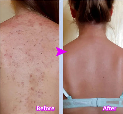 Curing Keratosis Pilaris Chicken Follicle Skin Repair Cream Body Dark Spot Remove Whitening Smooth Moisturize Skincare Body loti