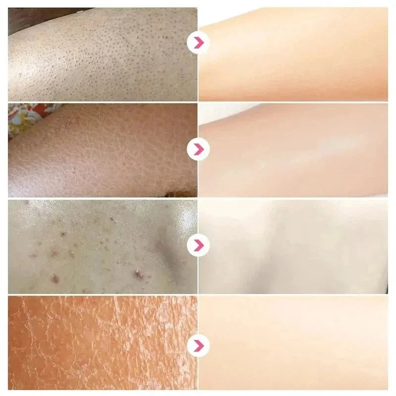 Curing Keratosis Pilaris Chicken Follicle Skin Repair Cream Body Dark Spot Remove Whitening Smooth Moisturize Skincare Body loti