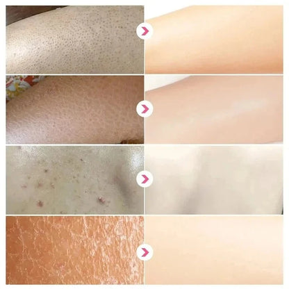 Curing Keratosis Pilaris Chicken Follicle Skin Repair Cream Body Dark Spot Remove Whitening Smooth Moisturize Skincare Body loti
