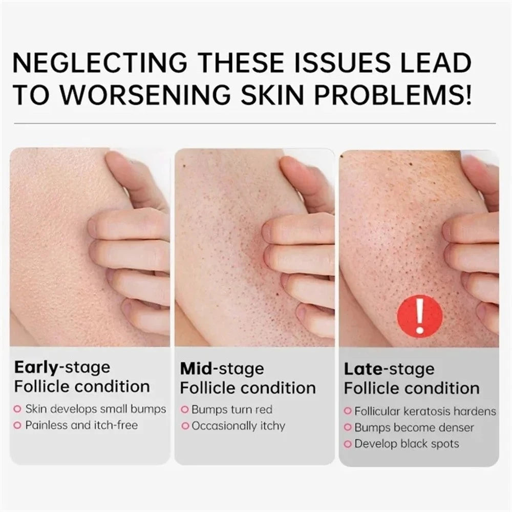 Curing Keratosis Pilaris Chicken Follicle Skin Repair Cream Body Dark Spot Remove Whitening Smooth Moisturize Skincare Body loti