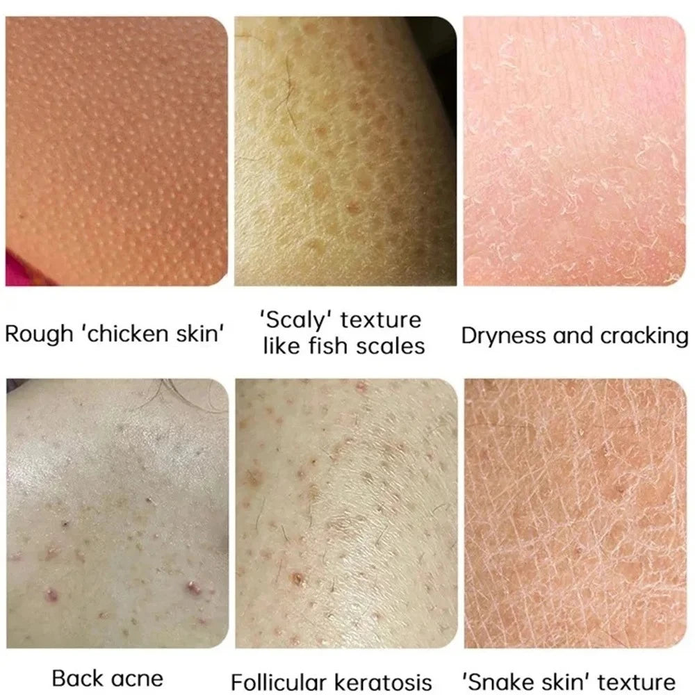 Curing Keratosis Pilaris Chicken Follicle Skin Repair Cream Body Dark Spot Remove Whitening Smooth Moisturize Skincare Body loti