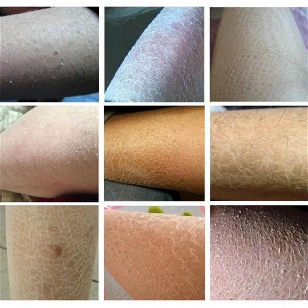 Curing Keratosis Pilaris Chicken Follicle Skin Repair Cream Body Dark Spot Remove Whitening Smooth Moisturize Skincare Body loti