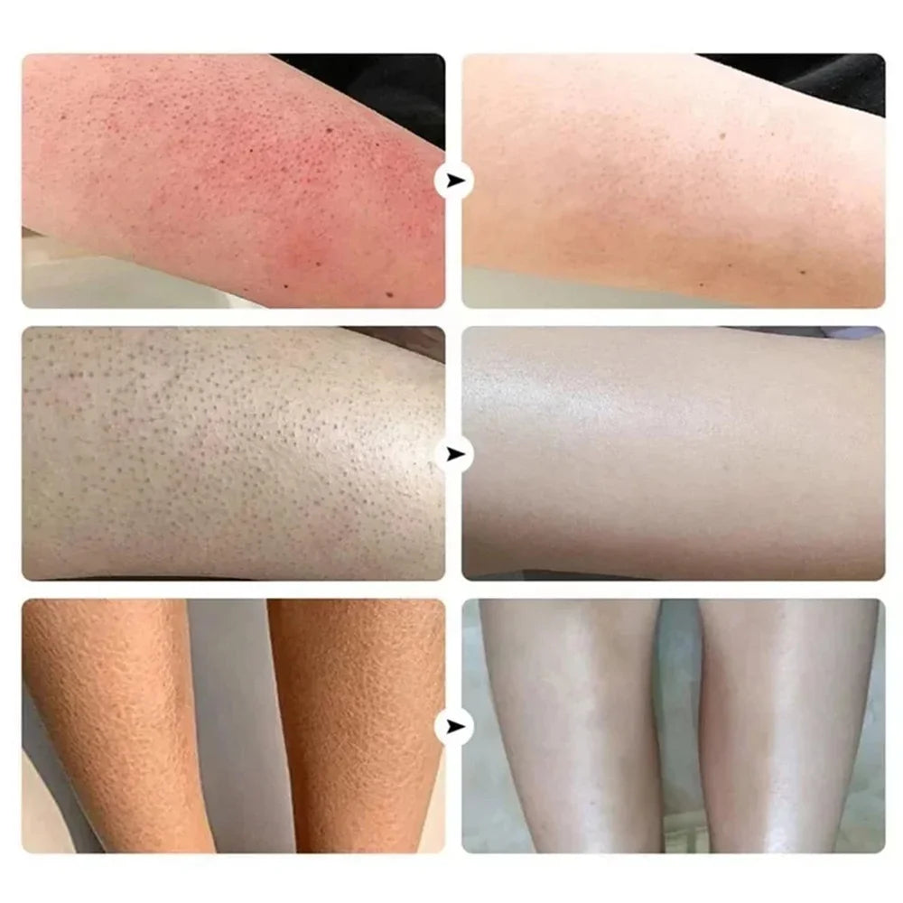 Curing Keratosis Pilaris Chicken Follicle Skin Repair Cream Body Dark Spot Remove Whitening Smooth Moisturize Skincare Body loti